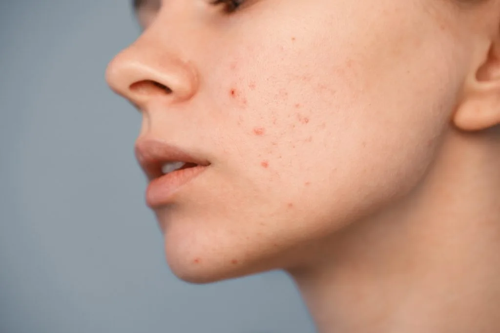 Close-up profile view of person's face showing acne on cheek and jawline against blue background